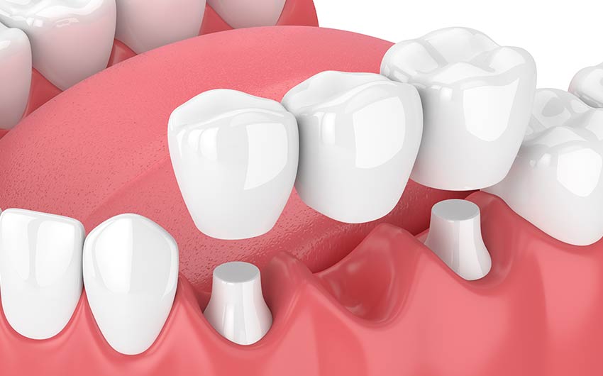 Dental Bridges | Dental on 8th | SE Calgary | General and Family Dentist