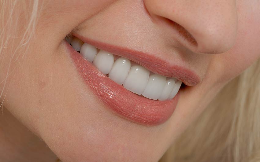 Porcelain Veneers | Dental on 8th | SE Calgary | General and Family Dentist