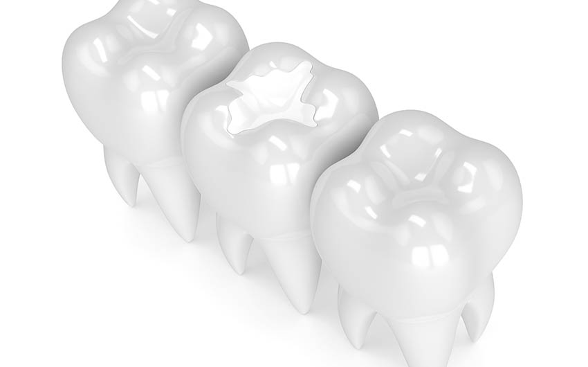 Tooth Coloured Fillings | Dental on 8th | SE Calgary | General and Family Dentist
