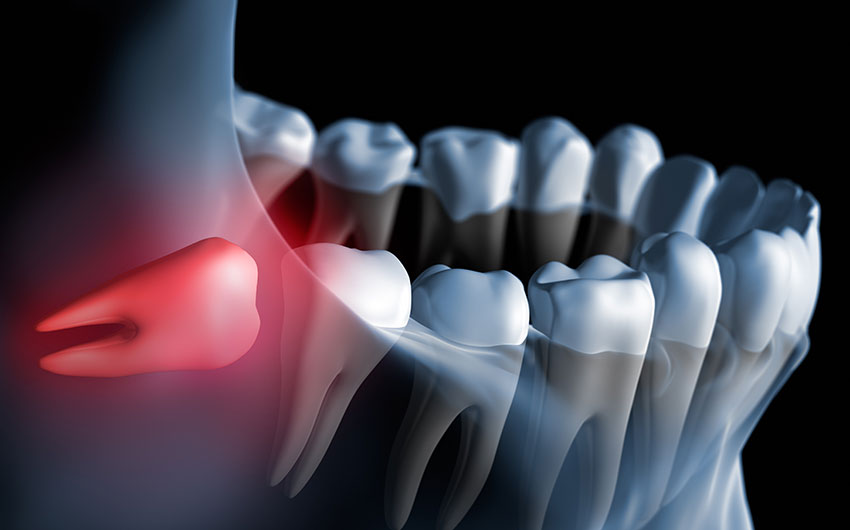 Wisdom Teeth Extraction | Dental on 8th | SE Calgary | General and Family Dentist