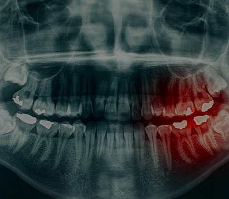 Wisdom Teeth Removal | Dental on 8th | SE Calgary | General and Family Dentist